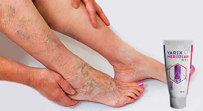 настойка для лечения варикоза на ногах